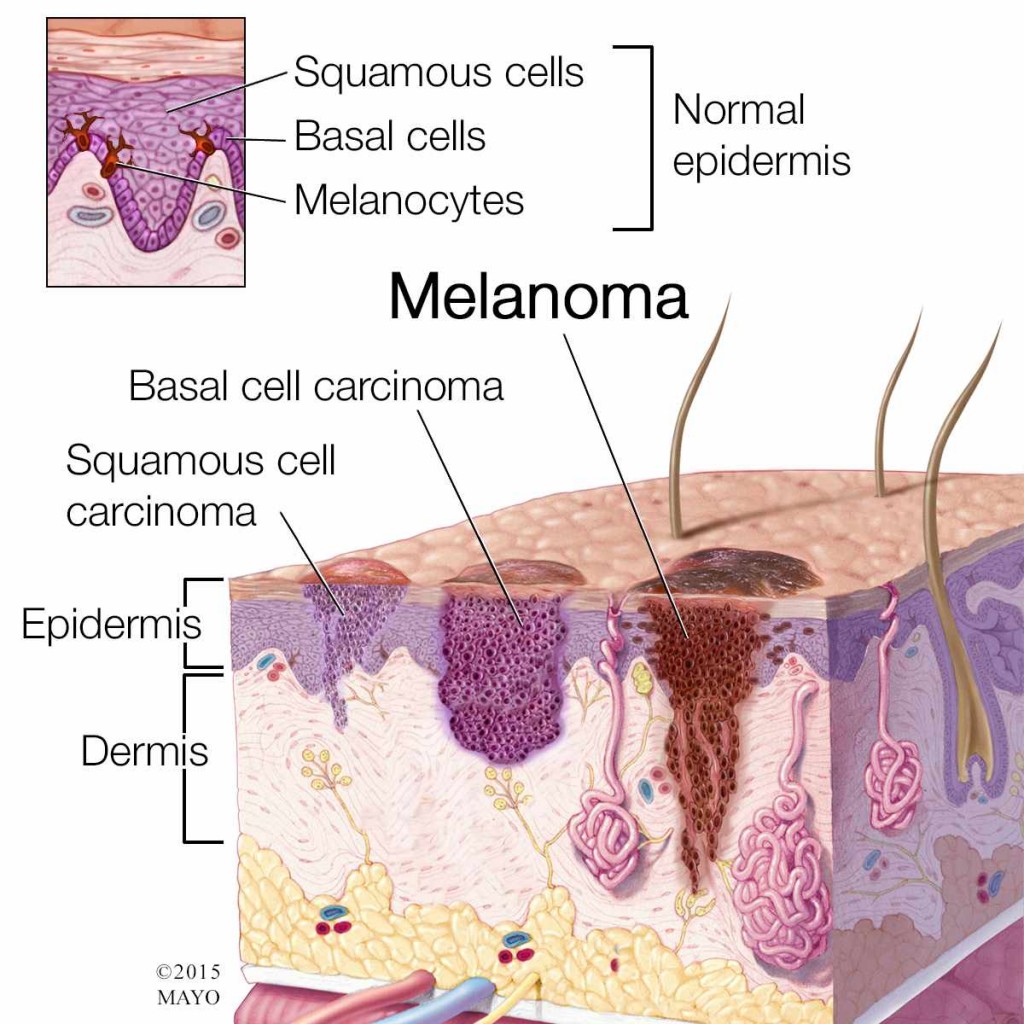 medical illustration of melanoma