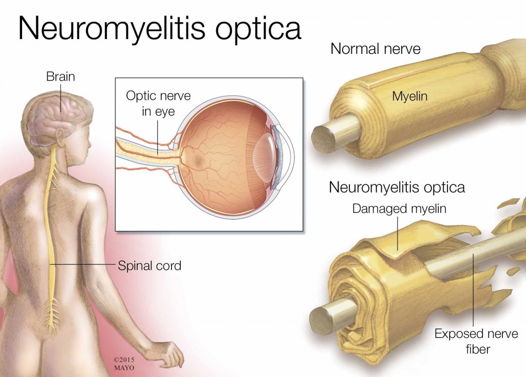 medical illustration of neuromyelitis optica, brain, spinal cord, nerve