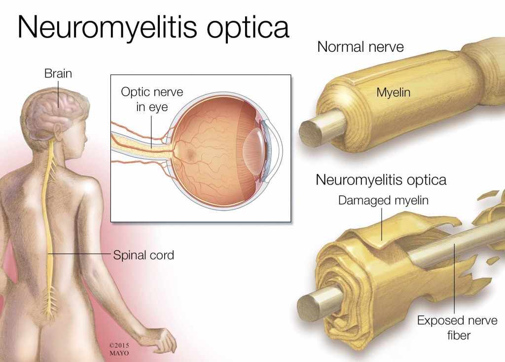 Ilustración médica de la neuromielitis óptica, del cerebro, de la médula espinal y del nervio
