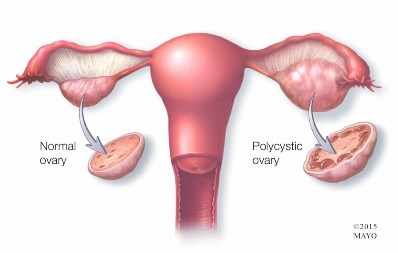 Ilustración médica de un ovario normal (izquierda) y de un ovario poliquístico (derecha).
