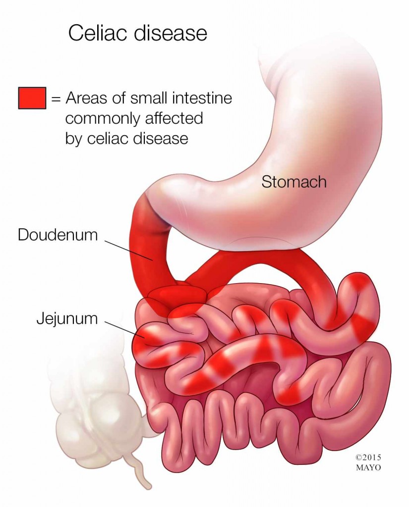 medical illustration of Celiac disease, areas of bowel