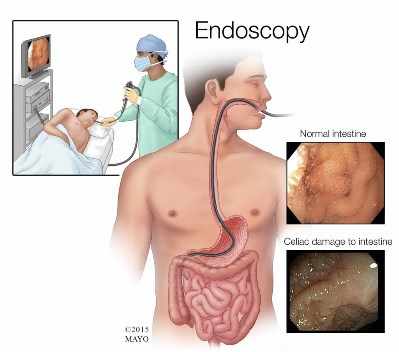Ilustración médica de la endoscopia para enfermedad celíaca