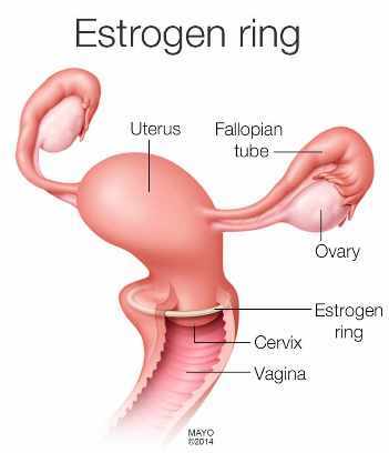 Ilustración médica del anillo con estrógenos
