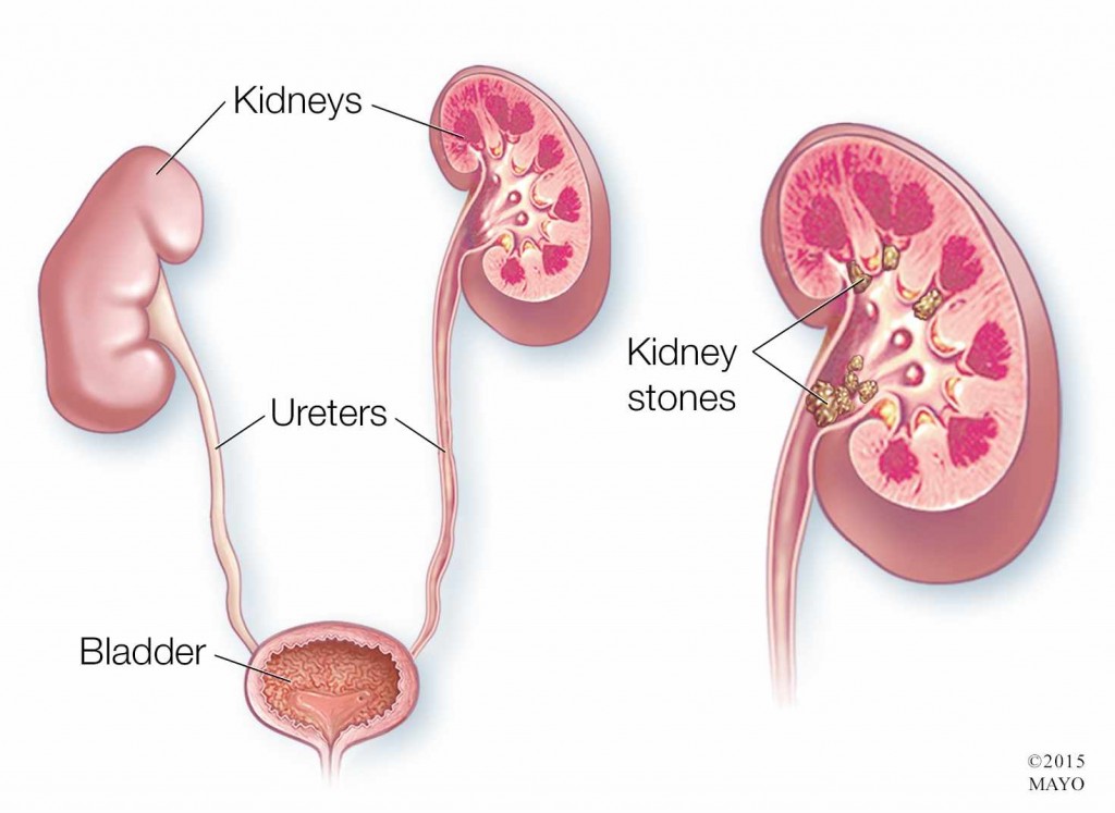 medical illustration of kidneys, bladder, ureters, kidney stones