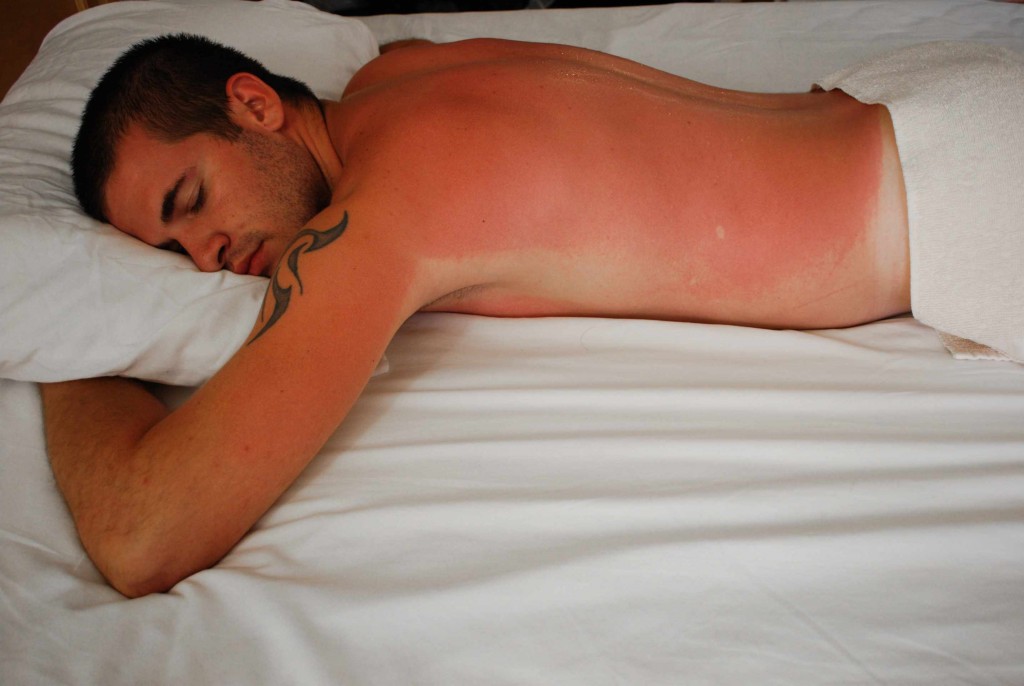 man with bright red sunburn on his back, sleeping in bed