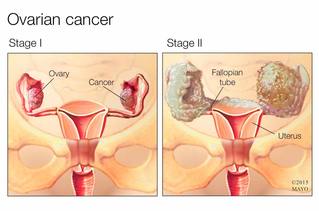 medical illustration of stage I and II ovarian cancer