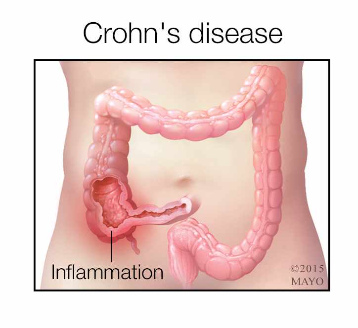 medical illustration for Crohn's disease, intestinal inflammation
