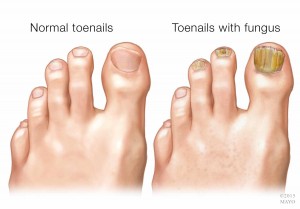 medical illustration of toenail fungal infection