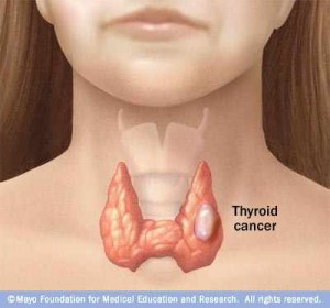 medical illustration of thyroid cancer