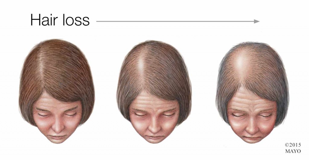 medical illustration of woman with hair loss