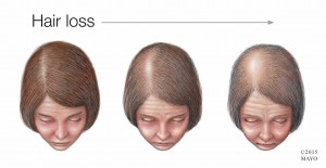 Ilustración médica de una mujer con pérdida del cabello