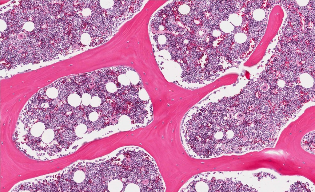 normal healthy bone marrow depicting erythroid and myeloid cells
