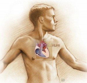 medical illustration of man with HLHS
