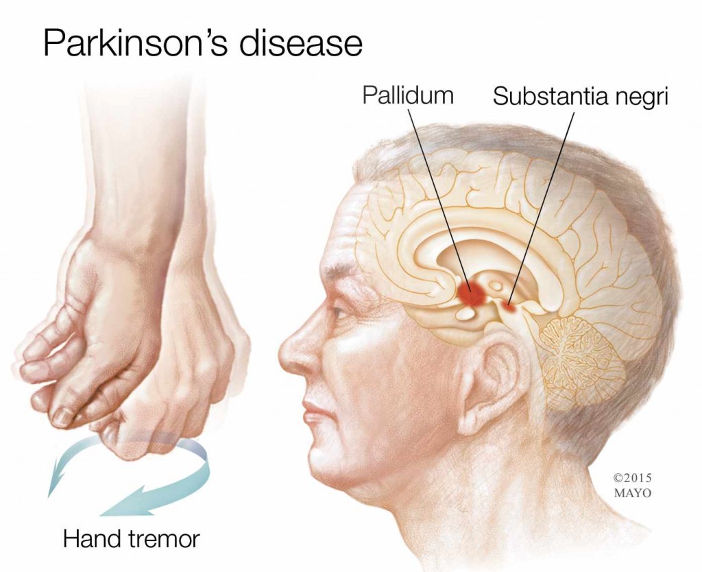 medical illustration showing hand tremor due to Parkinson's Disease, and location of the disease in the brain