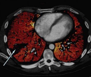 Imagen de una tomografía computarizada de una embolia pulmonar