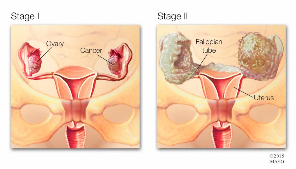 Ilustración médica del cáncer de ovario en etapa 1 y 2