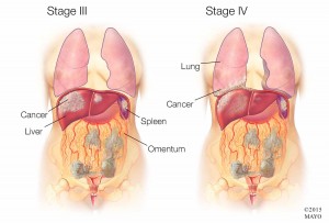 Ilustración médica del cáncer de ovario en etapa 3 y 4