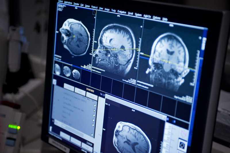 computer monitor of brain image of patient with epilepsy