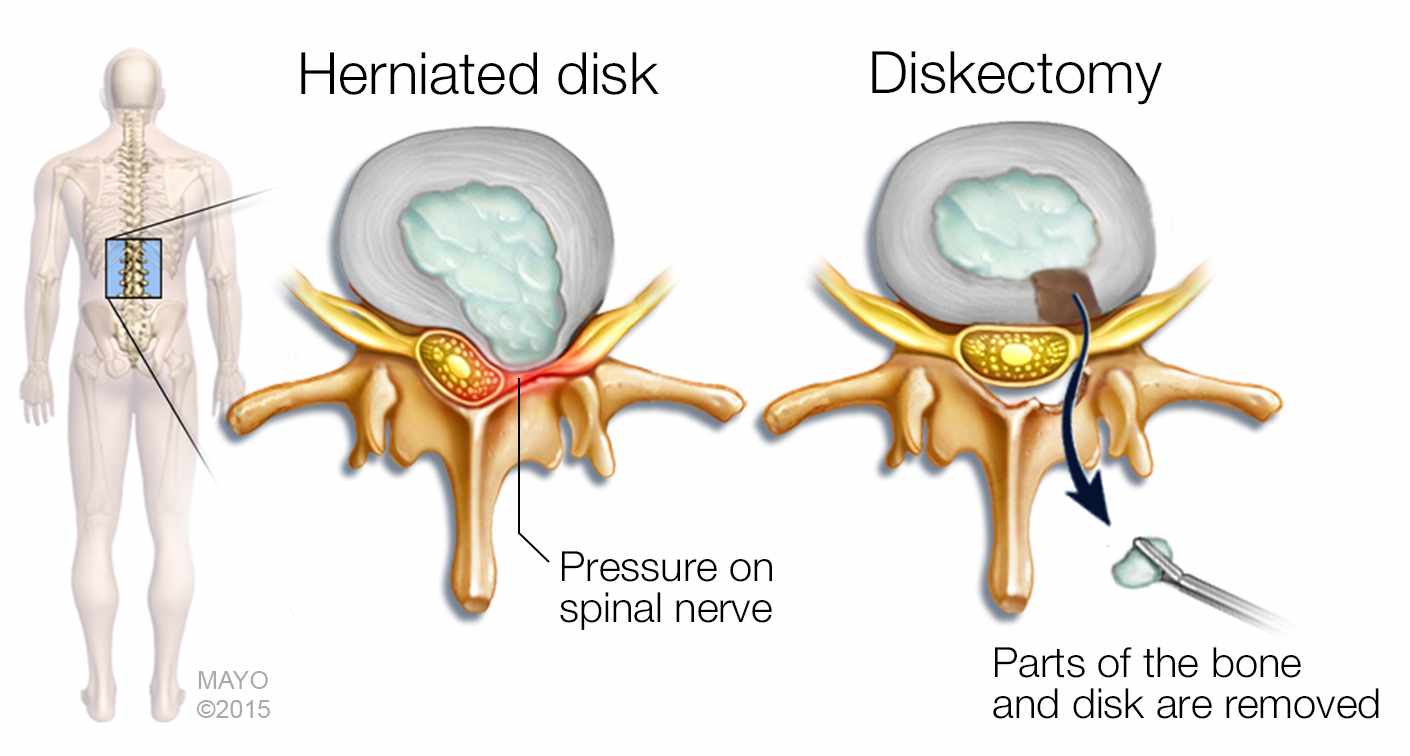 Mayo Clinic Q and A: Herniation can happen to a disk for a number