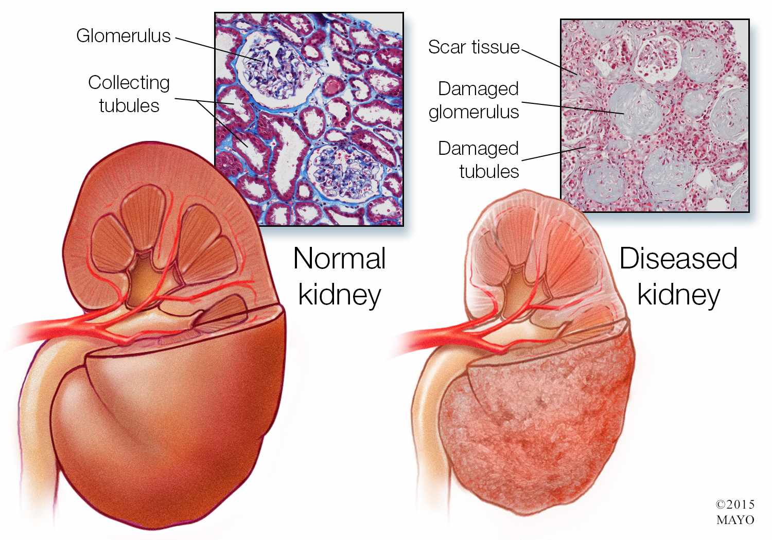 medical illustration of normal kidney and diseased kidney