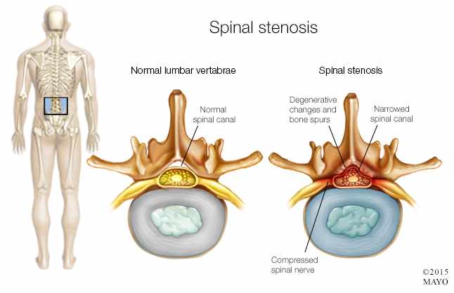 medical illustration o f spinal stenosis