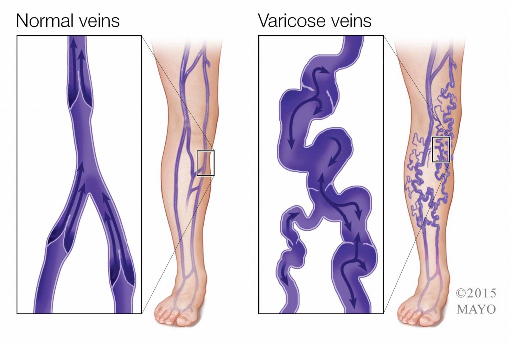 Ilustración médica de venas varicosas