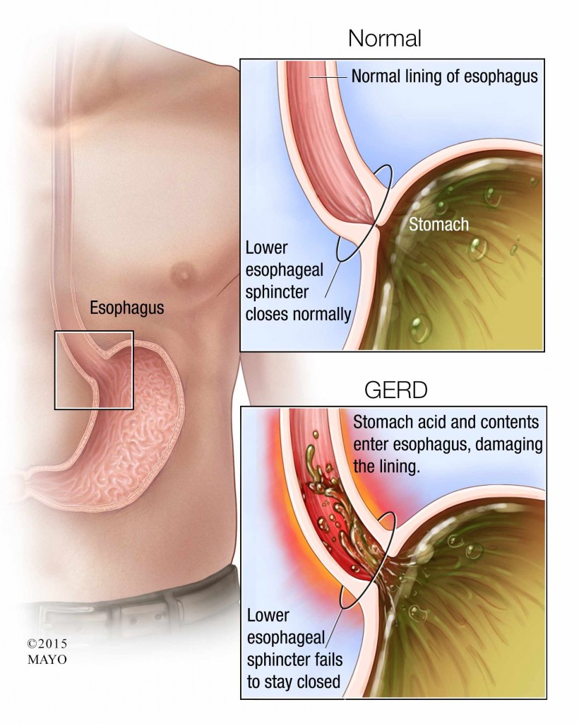 medical illustration for GERD esophagus