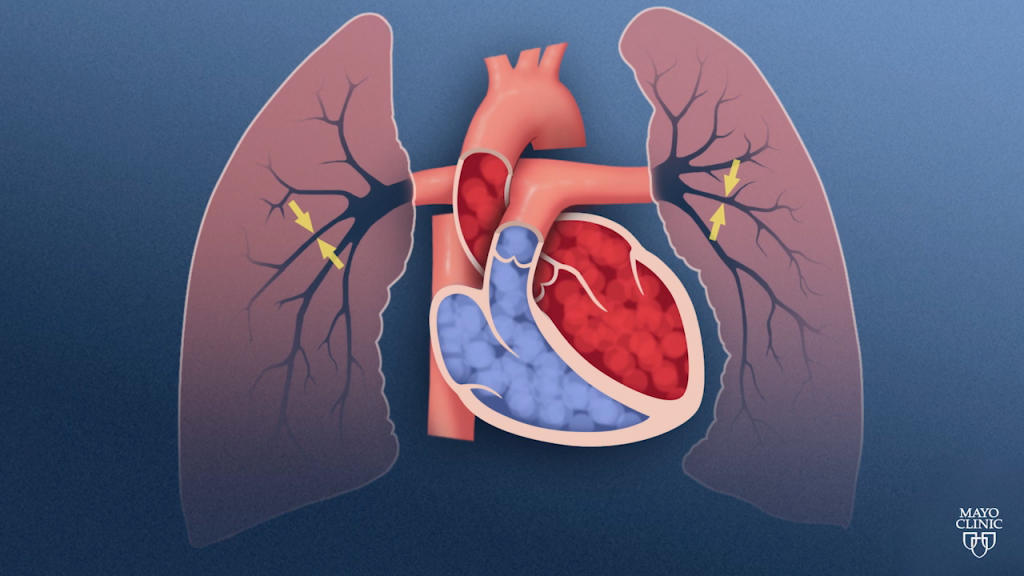 Pulmonary hypertension is a disorder of the lungs that affects the way blood is pumped and circulated.