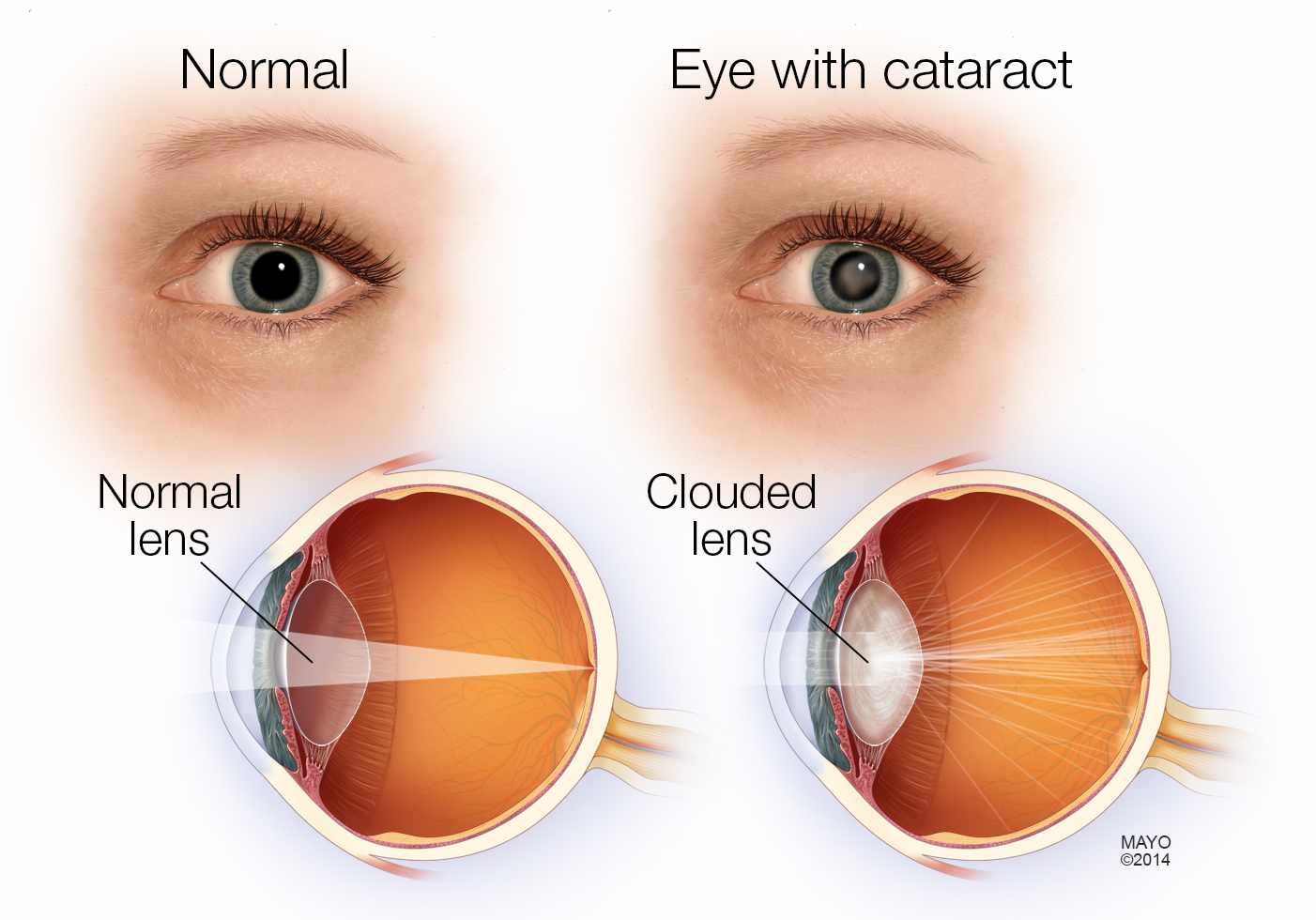 medical illustration of a normal eye and an eye with a cataract, clouded lens