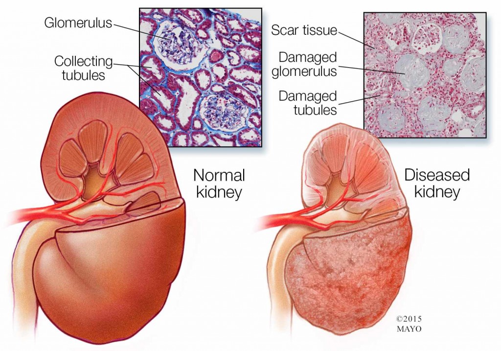 Ilustración médica de un riñón normal (izquierda) y un riñón enfermo (derecha)
