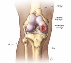 medical illustration of a knee and damaged cartilage