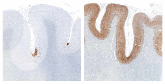 Sobre la izquierda, proteína tau anormal (color café) en una muestra de tejido cerebral con encefalopatía traumática crónica; sobre la derecha, la enfermedad de Alzheimer. 