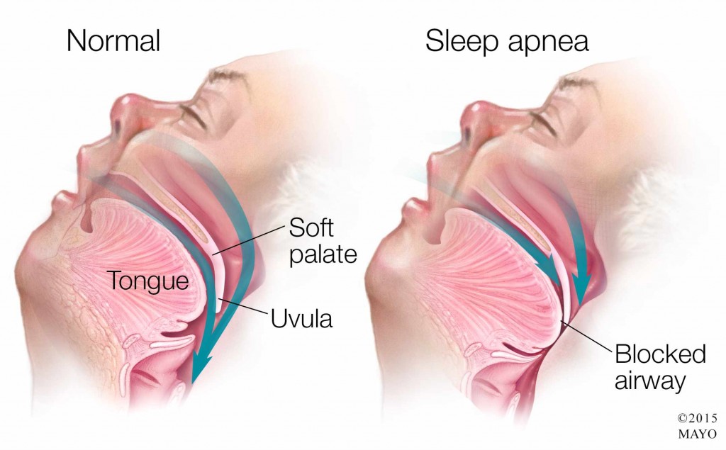 medical illustration of sleep apnea