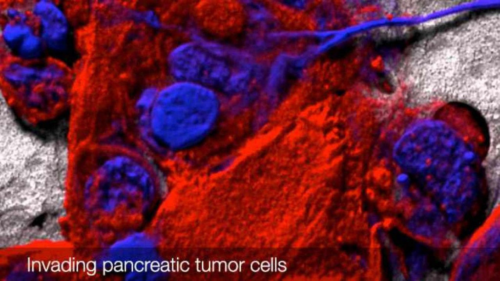 Laminilla de microscopio con células de tumor pancreático