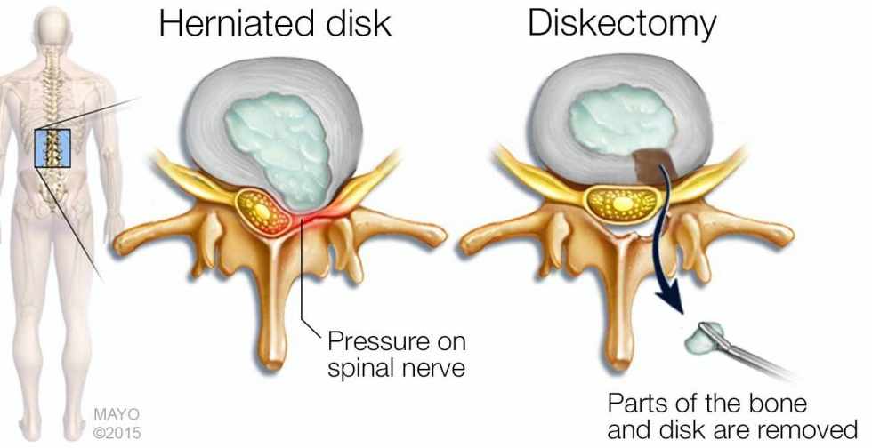 Ilustración médica de la escisión de un disco herniado