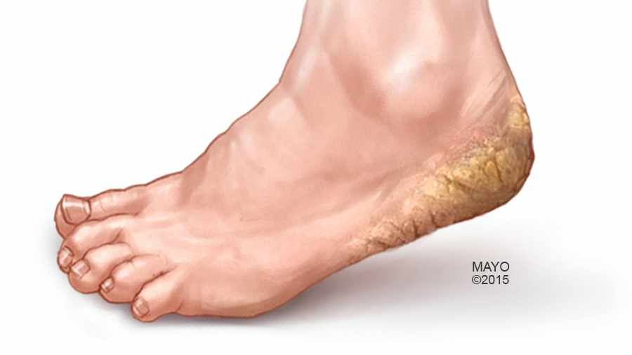 medical illustration of foot with cracked skin on heel