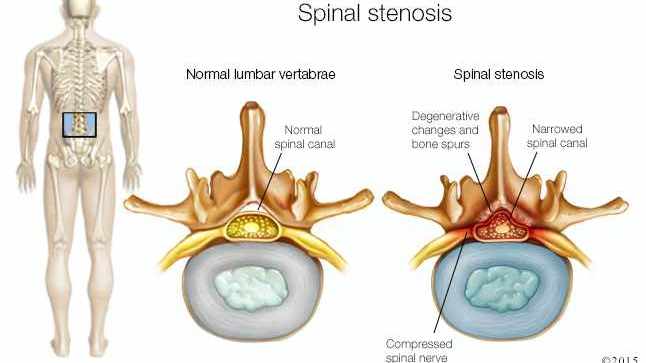Ilustración médica de la estenosis espinal