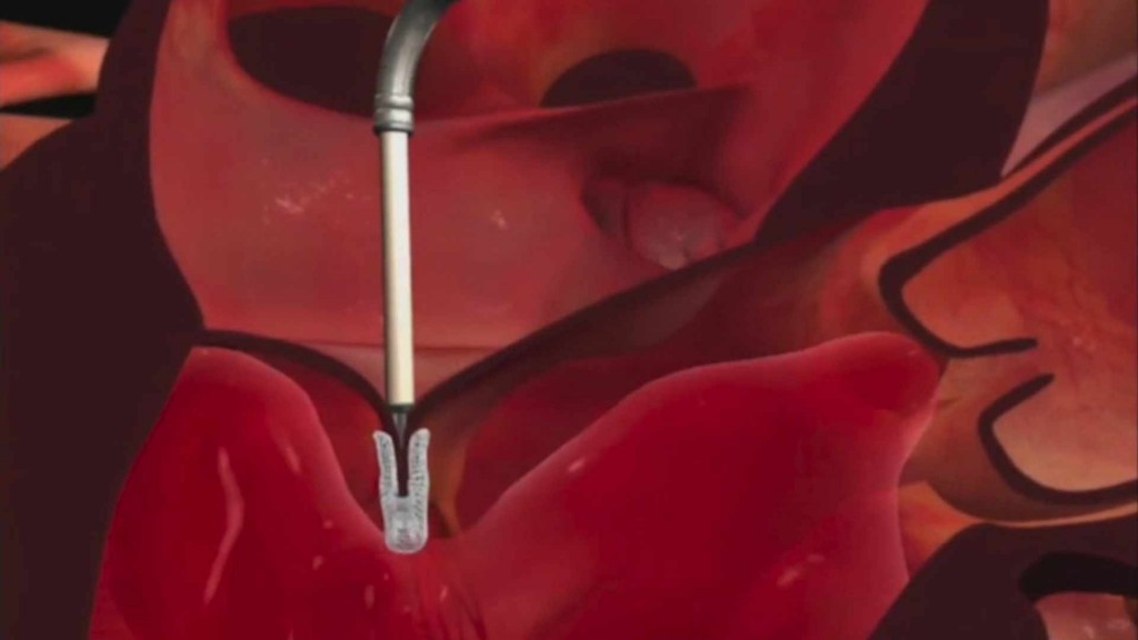 Illustration of the mitral valve clip being placed in the body.