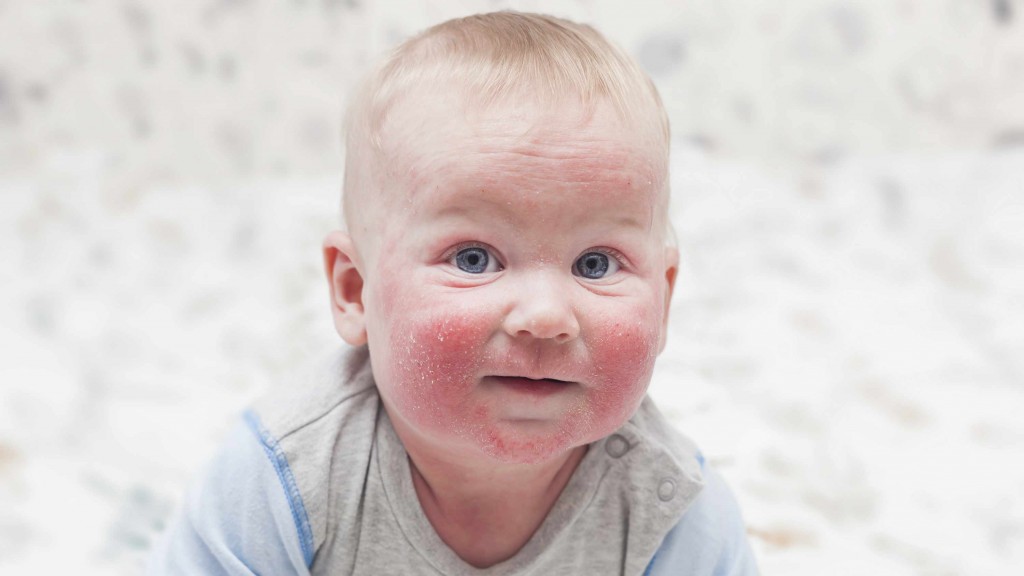 baby with red, chapped cheeks, eczema, dermatitis