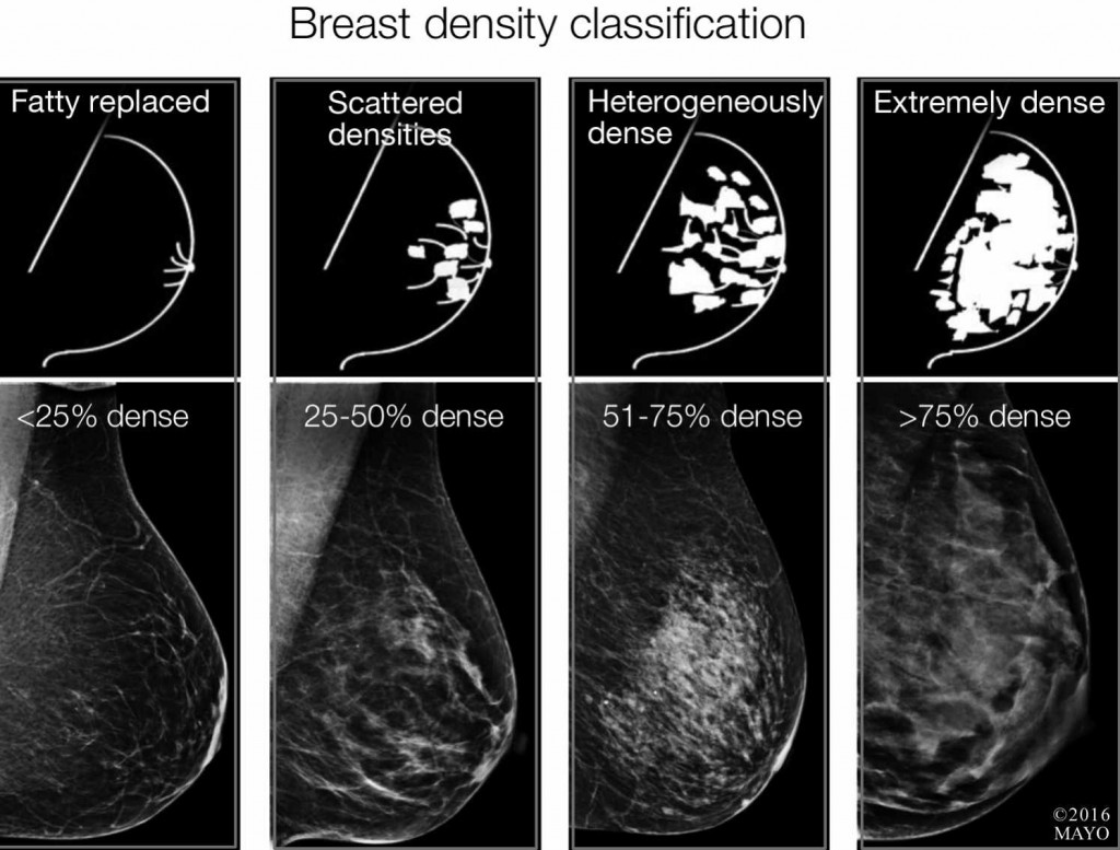 Radiografías e imágenes de la clasificación de la densidad mamaria