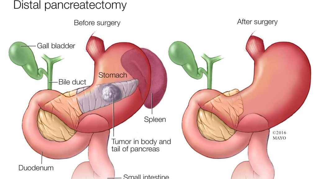 Ilustración médica de la prancreatectomía distal