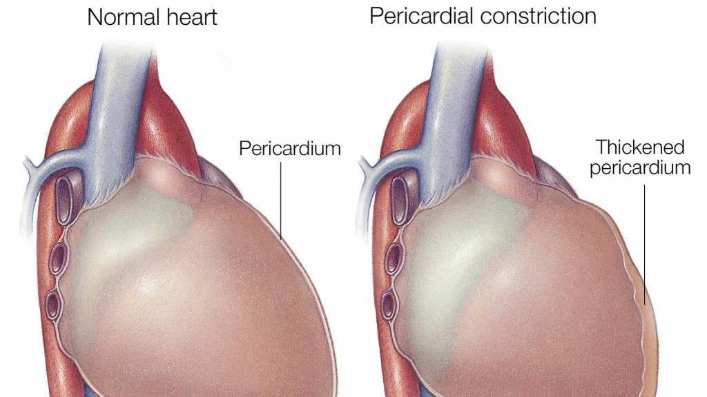 Ilustración médica de un corazón normal sobre la izquierda y de otro con constricción pericárdica sobre la derecha. 