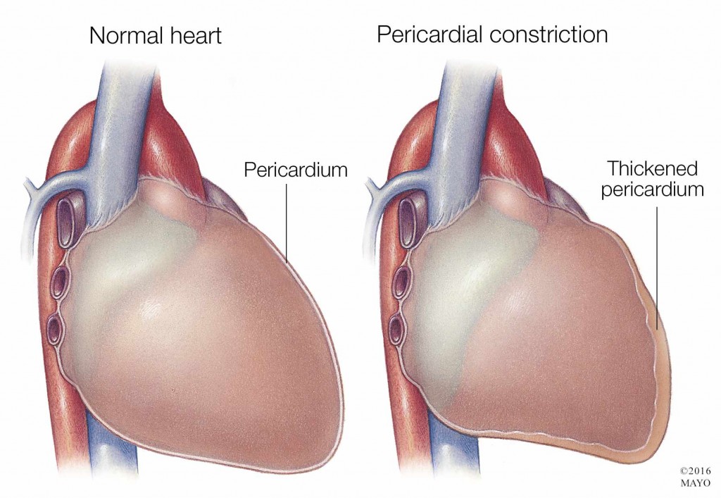 medical illustration of normal heart and heart with pericardial constriction