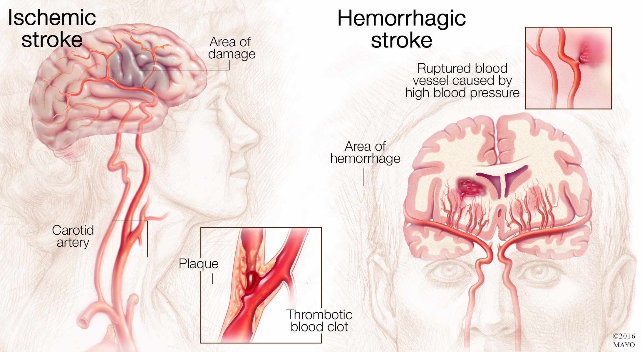 Ilustración médica de un cerebro con accidente cerebrovascular isquémico (izquierda) y accidente cerebrovascular hemorrágico (derecha)