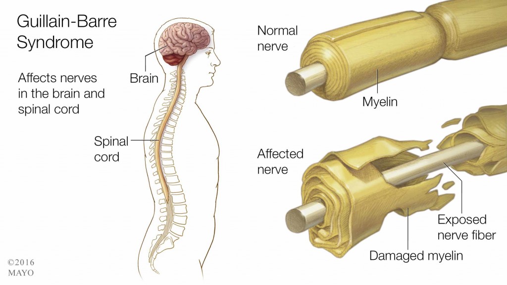 a medical illustration of a normal nerve and a damaged nerve in the spine, Guillain-Barre Syndrome