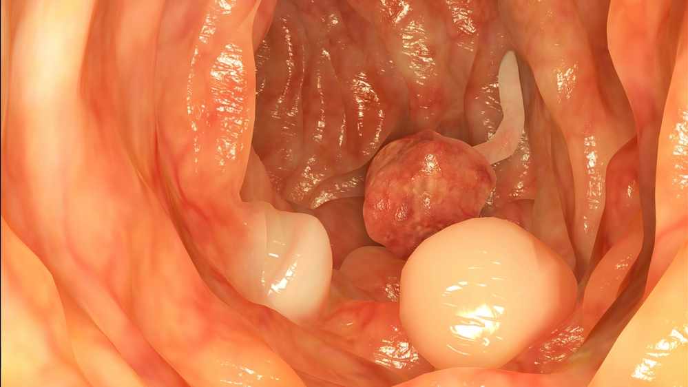 pólipos intestinales