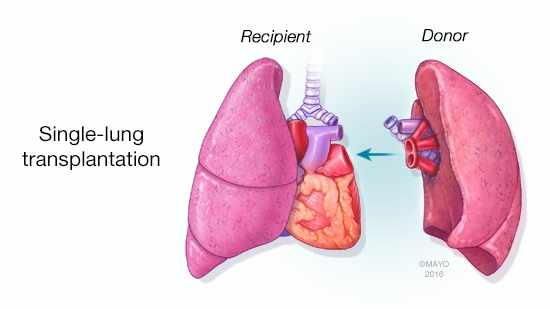 a medical illustration of single-lung transplant