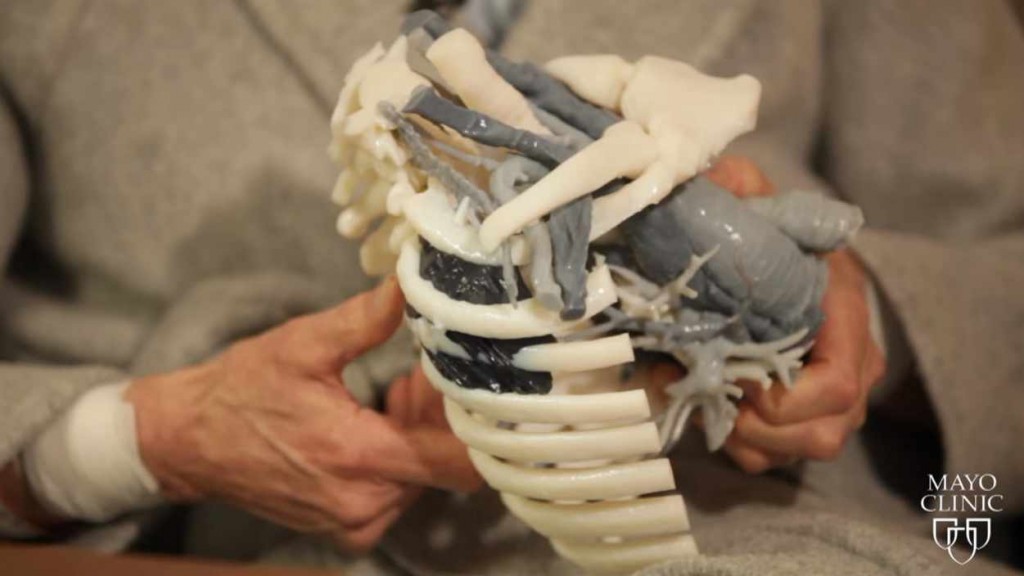 a patient holding a 3D model of rib cage with a tumor