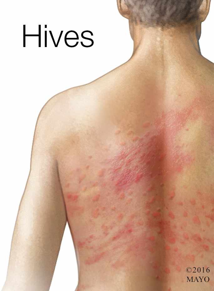 Women with symptoms of itchy urticaria or allergic reaction on the