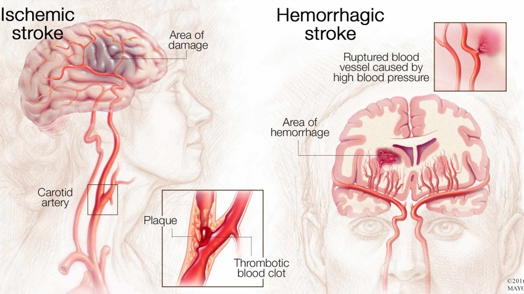 medical illustration of brain with ischemic stroke and hemorrhagic stroke